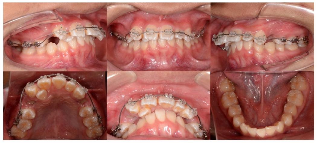 图3. Intra-oral photographs during initial alignment