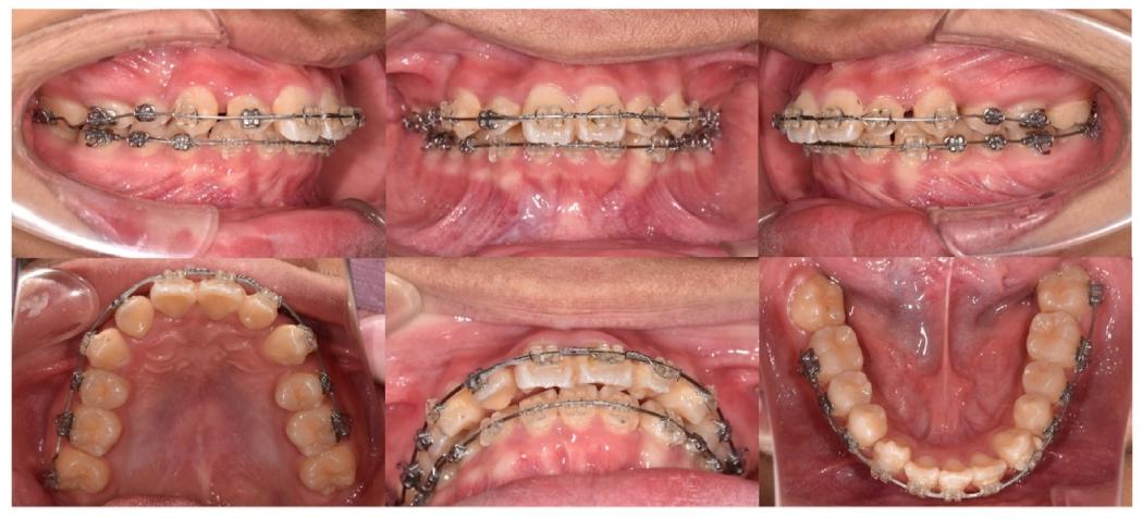 图6. Period of active treatment: the 14th months